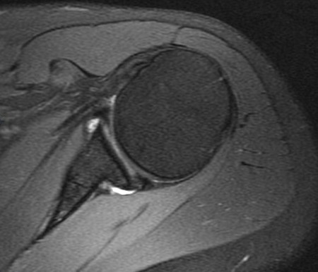 Figure 3 for case SLAP lesion with labral cyst and suprascapular nerve compression Also nearly circumferential labral tear